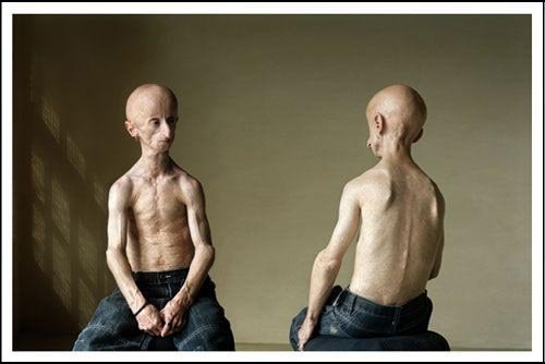 Leon Botha with rare disease Progeria