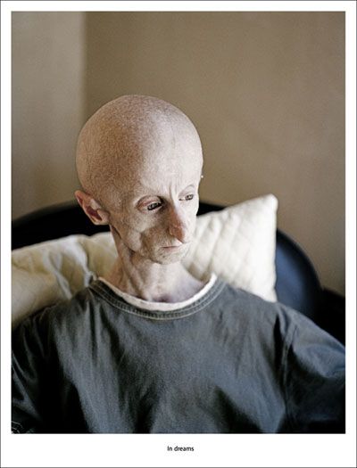 Leon Botha with rare disease Progeria