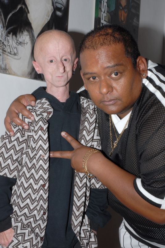Leon Botha with rare disease Progeria