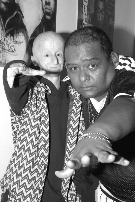 Leon Botha with rare disease Progeria