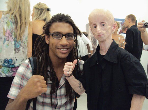 Leon Botha with rare disease Progeria