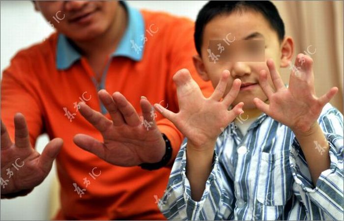 Chinese boy with 30 fingers and toes