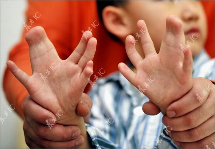 Chinese boy with 30 fingers and toes