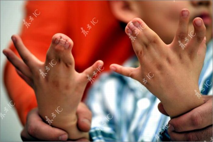 Chinese boy with 30 fingers and toes