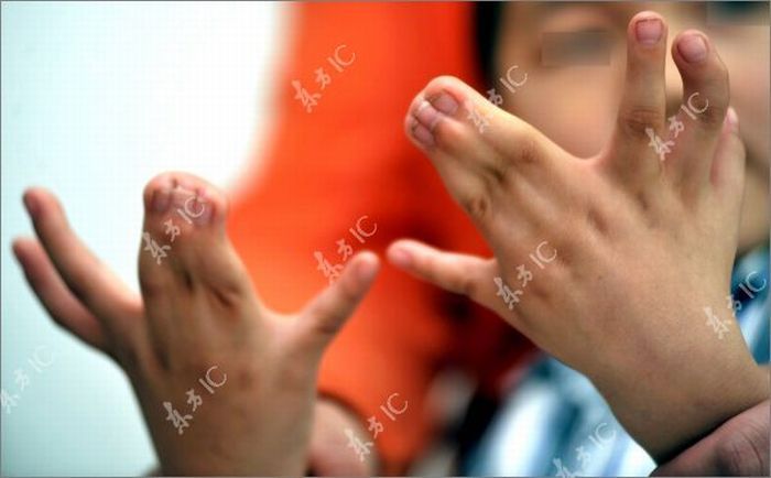 Chinese boy with 30 fingers and toes