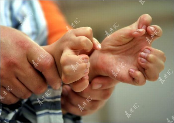 Chinese boy with 30 fingers and toes