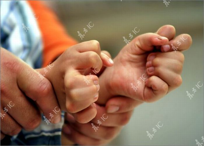 Chinese boy with 30 fingers and toes