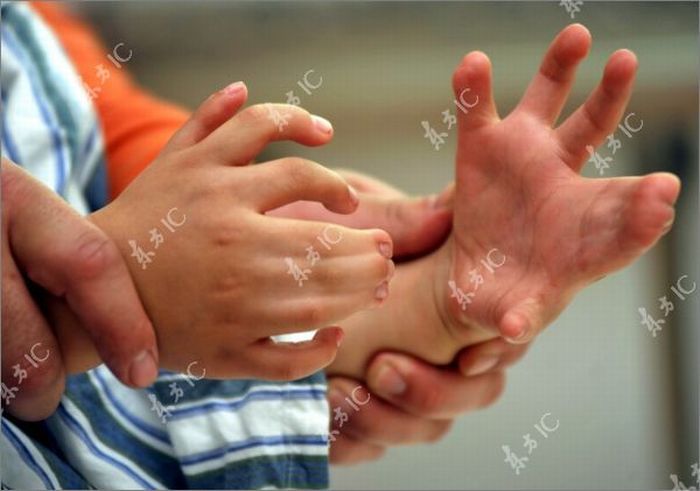 Chinese boy with 30 fingers and toes