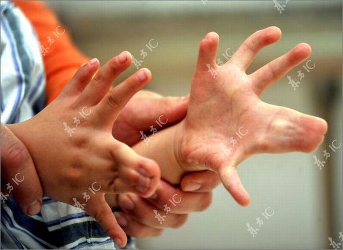 Chinese boy with 30 fingers and toes