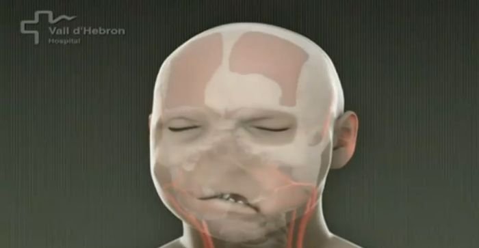 World's first full face transplant, Spain