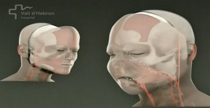 World's first full face transplant, Spain