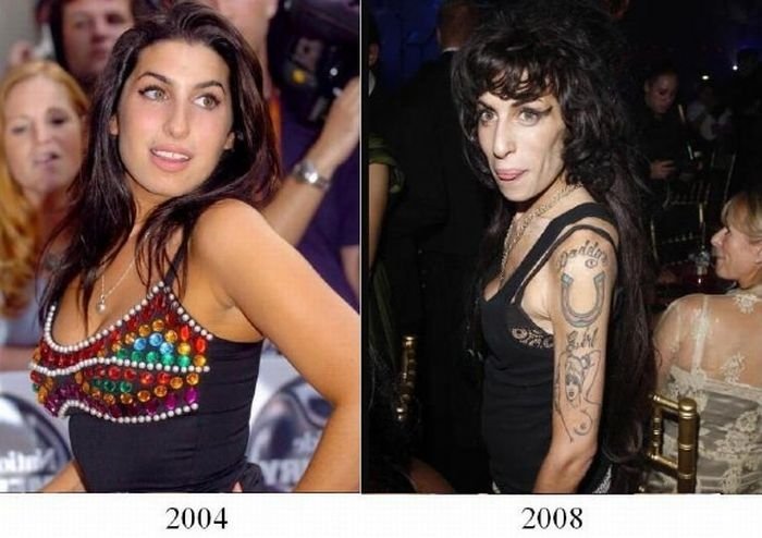 girl before and after anorexia