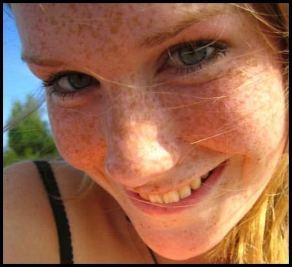 freckled girl