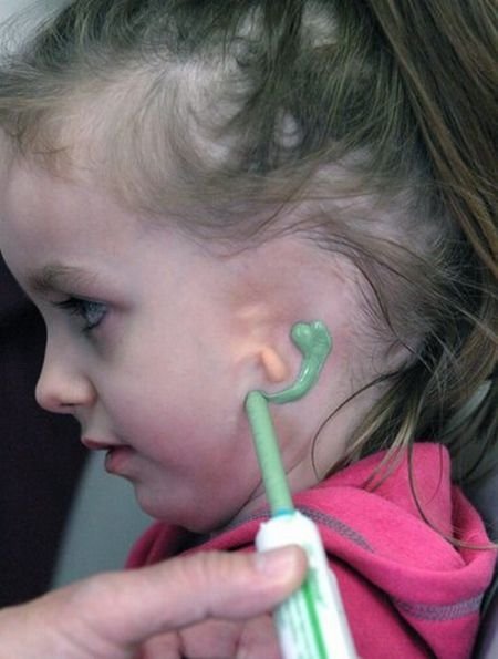 little girl gets new ear and cochlear implant