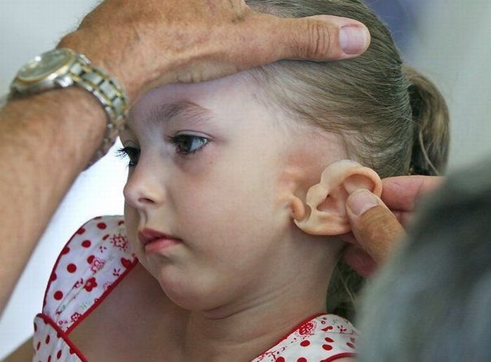 little girl gets new ear and cochlear implant