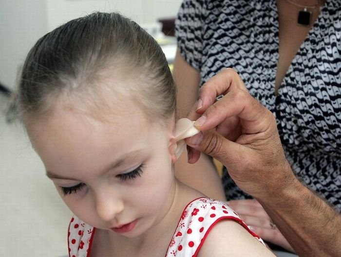 little girl gets new ear and cochlear implant