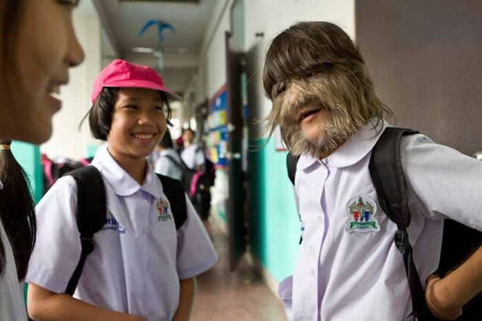 Supatra, child with ambras syndrome, Thailand