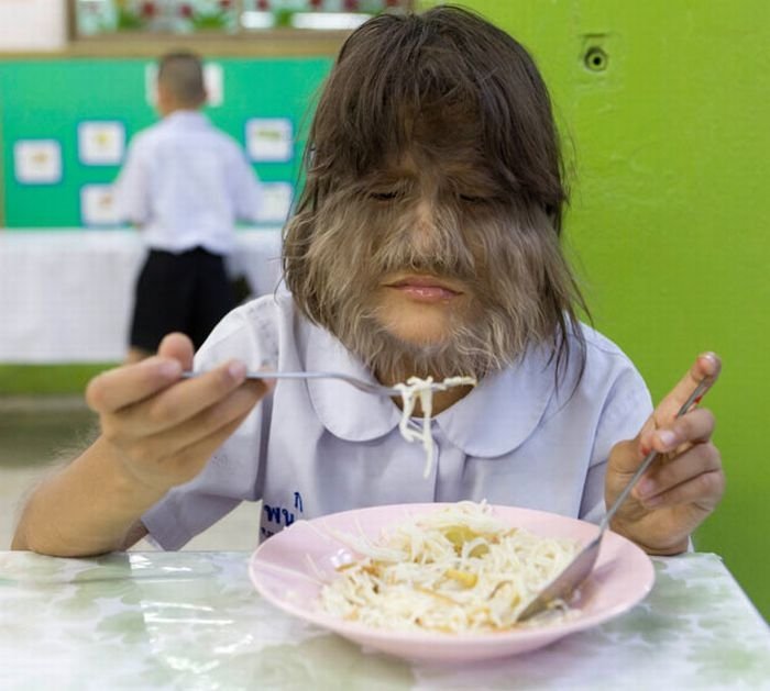 Supatra, child with ambras syndrome, Thailand