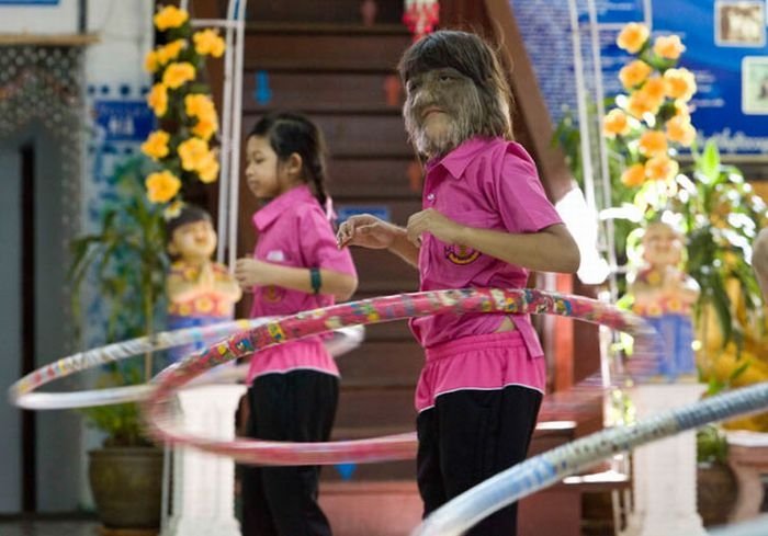 Supatra, child with ambras syndrome, Thailand