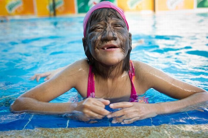 Supatra, child with ambras syndrome, Thailand