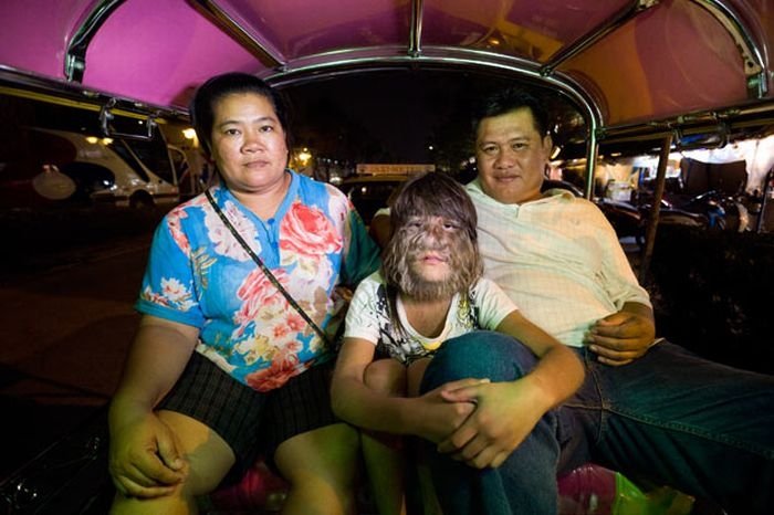 Supatra, child with ambras syndrome, Thailand