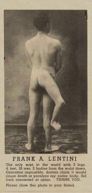 History: Francesco Lentini, man with three legs, Rosolini, Italy
