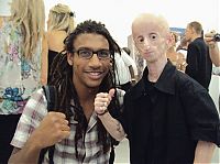 TopRq.com search results: Leon Botha with rare disease Progeria