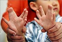 People & Humanity: Chinese boy with 30 fingers and toes