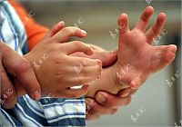 People & Humanity: Chinese boy with 30 fingers and toes