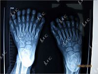 TopRq.com search results: Chinese boy with 30 fingers and toes