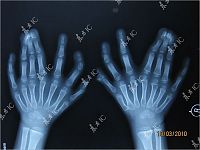 TopRq.com search results: Chinese boy with 30 fingers and toes