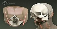 TopRq.com search results: World's first full face transplant, Spain
