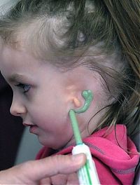 People & Humanity: little girl gets new ear and cochlear implant