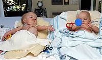 People & Humanity: Macey and Mackenzie Garrison, conjoined twins