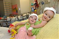 People & Humanity: Macey and Mackenzie Garrison, conjoined twins