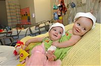 People & Humanity: Macey and Mackenzie Garrison, conjoined twins