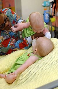 People & Humanity: Macey and Mackenzie Garrison, conjoined twins